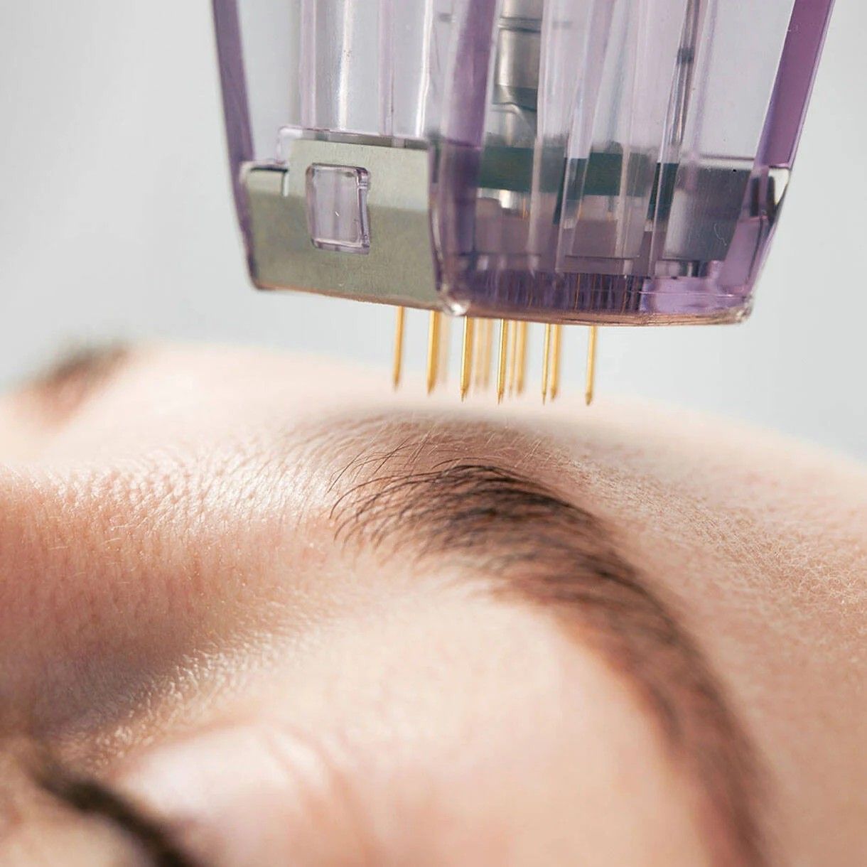 Morpheus8 RF microneedling