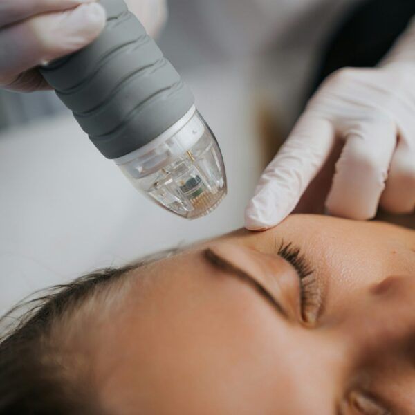 Microneedling
